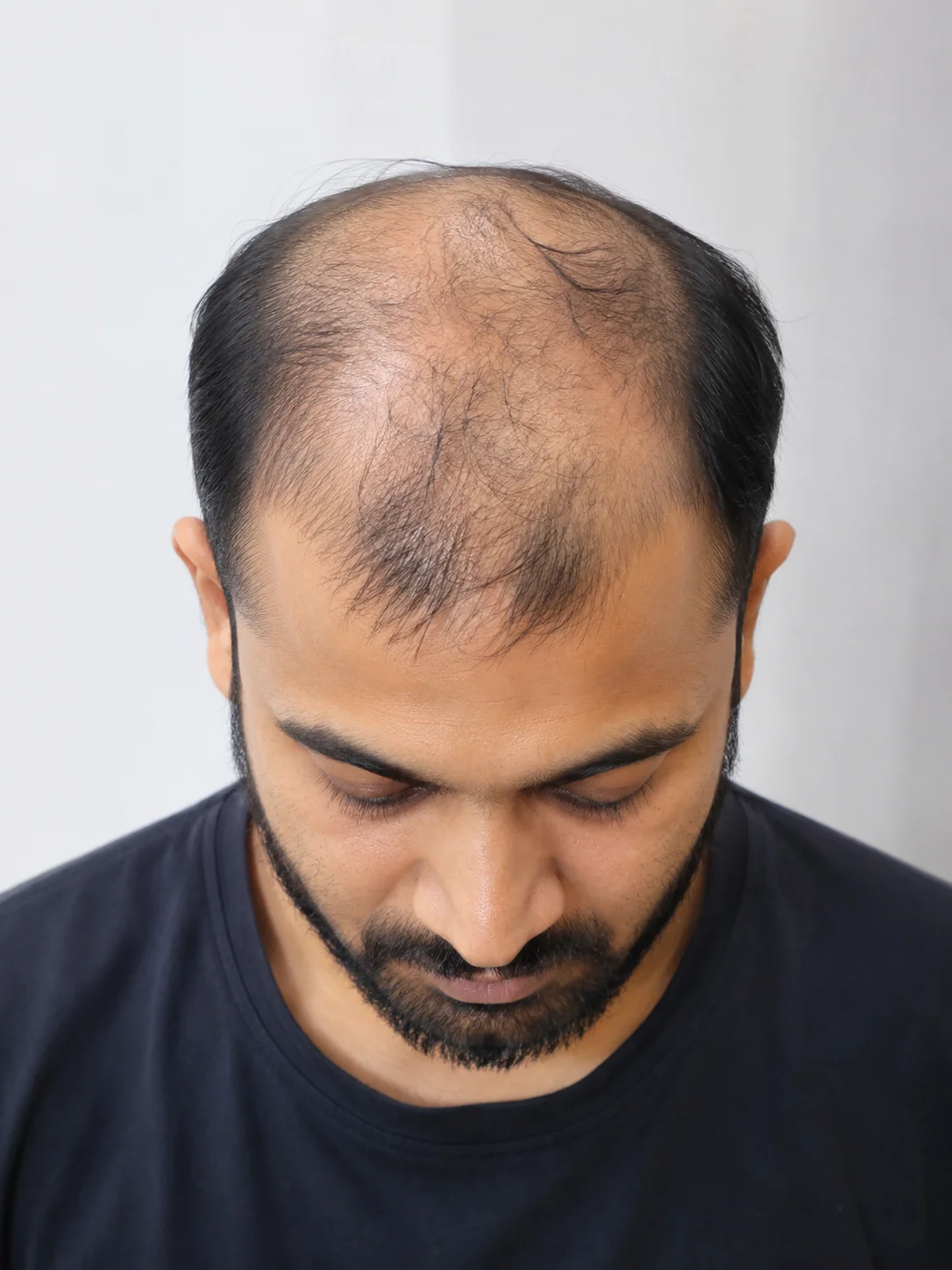 Hair Patch Transformation before