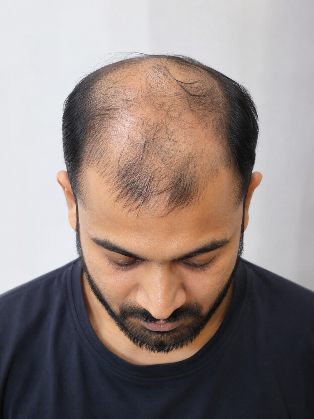 Hair Patch Transformation before