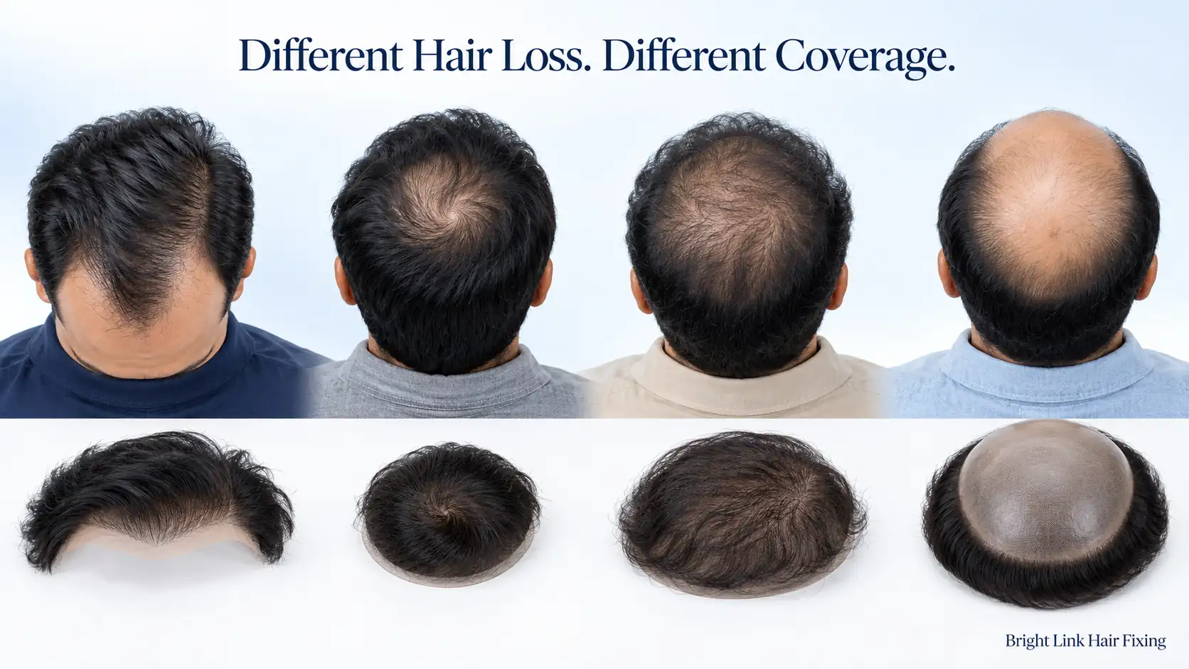 Hair Patch for Crown Thinning vs Full Baldness: Which Coverage Type Do You Need?